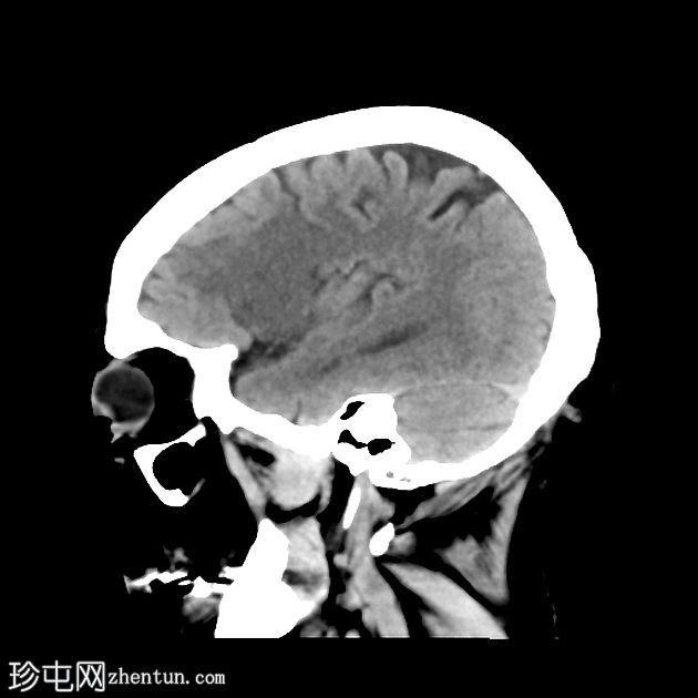 缺血性梗塞出血性转化