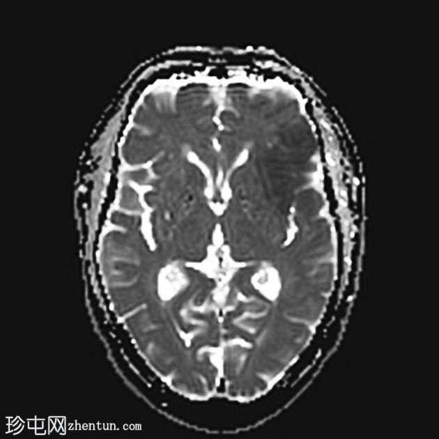 缺血性梗塞出血性转化