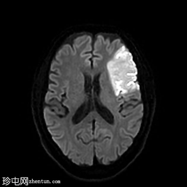 缺血性梗塞出血性转化