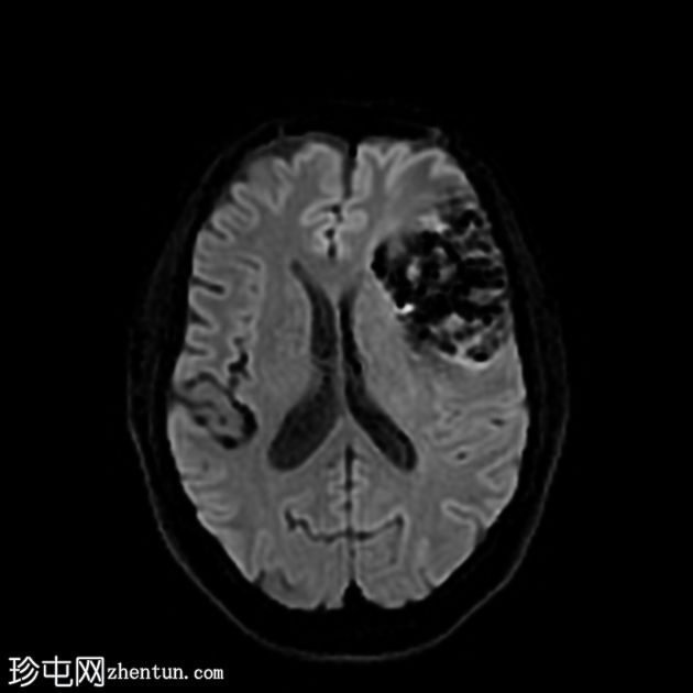 缺血性梗塞出血性转化