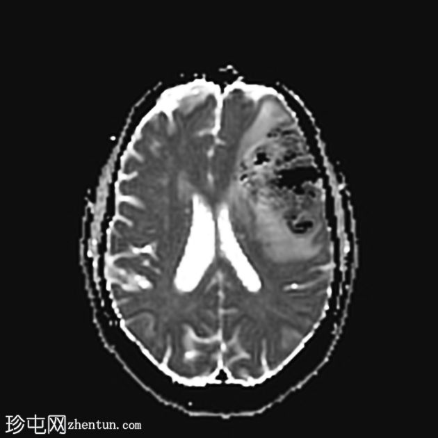 缺血性梗塞出血性转化