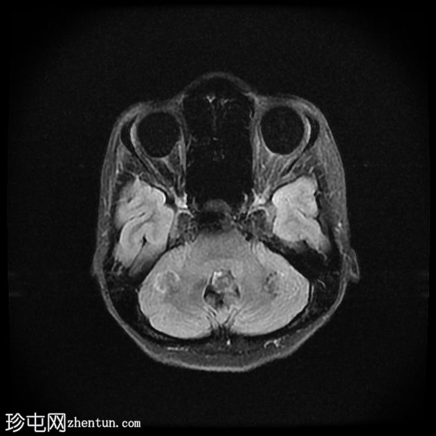 视中隔发育不良