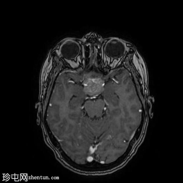 鞍结节脑膜瘤