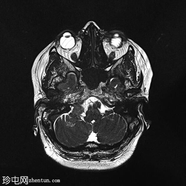 听神经瘤