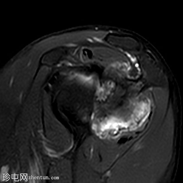 腰椎压缩性骨折