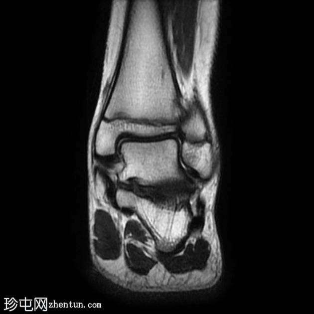 跟骨前突骨折