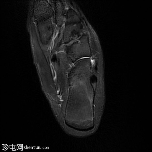 跟骨前突骨折