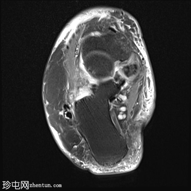 胫骨后肌腱功能障碍