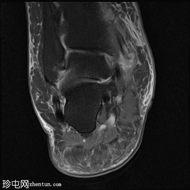 胫骨后肌腱功能障碍