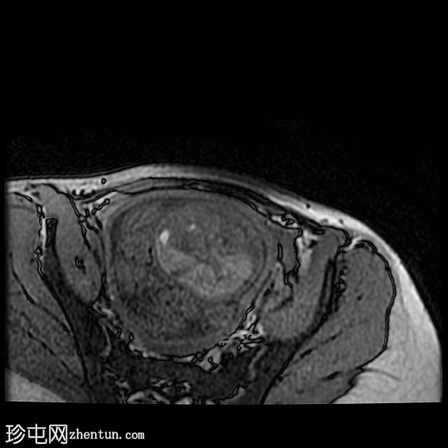 先天性肌内血管瘤（胎儿MRI）