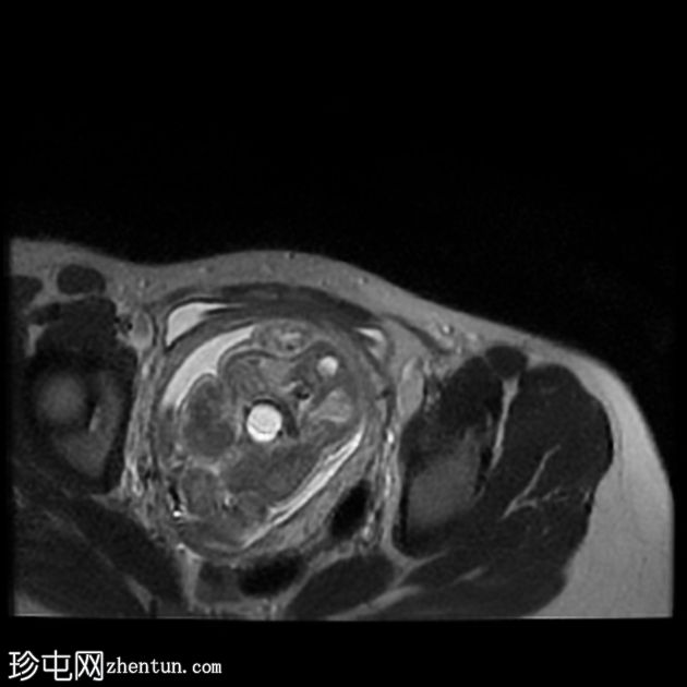 先天性肌内血管瘤（胎儿MRI）