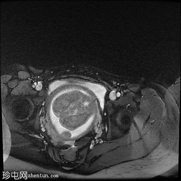 先天性肌内血管瘤（胎儿MRI）