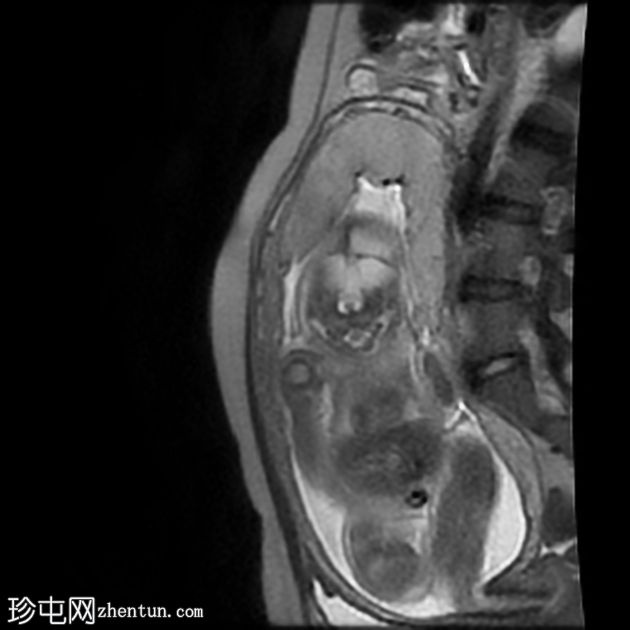 先天性肌内血管瘤（胎儿MRI）