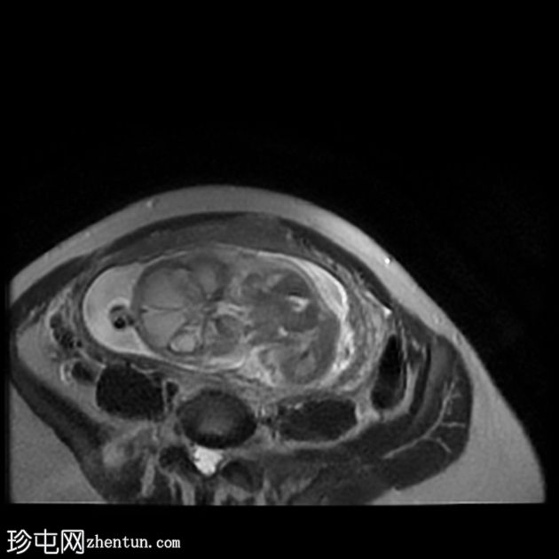 先天性肌内血管瘤（胎儿MRI）