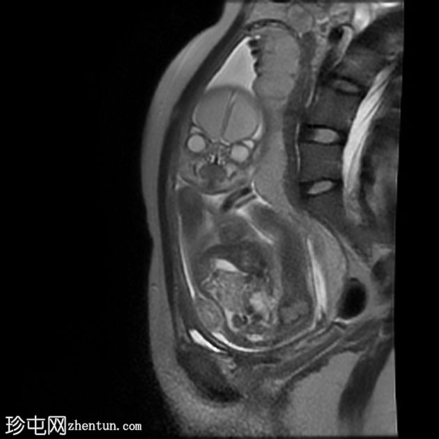 先天性肌内血管瘤（胎儿MRI）