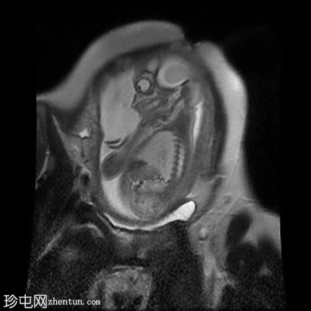 先天性肌内血管瘤（胎儿MRI）