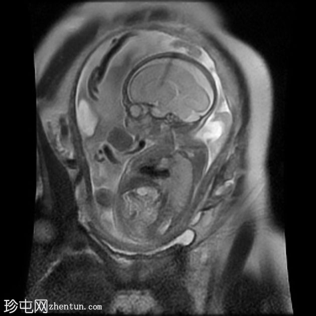 先天性肌内血管瘤（胎儿MRI）