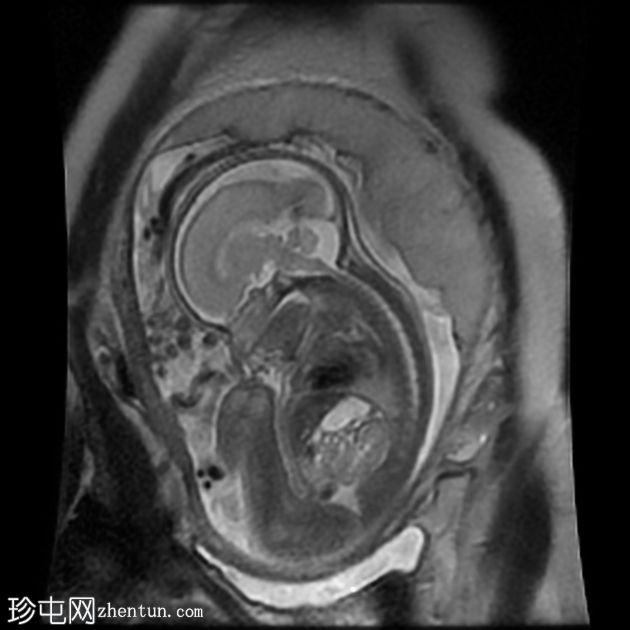 先天性肌内血管瘤（胎儿MRI）