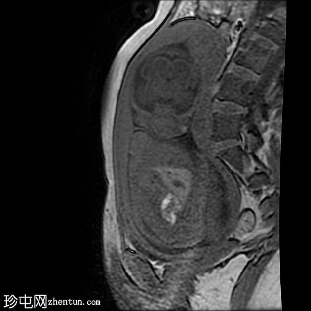 先天性肌内血管瘤（胎儿MRI）