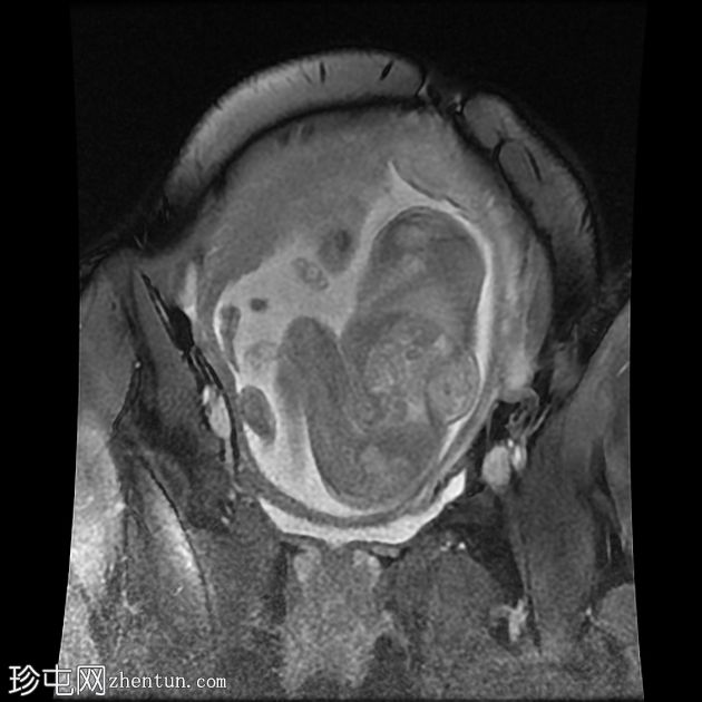 先天性肌内血管瘤（胎儿MRI）