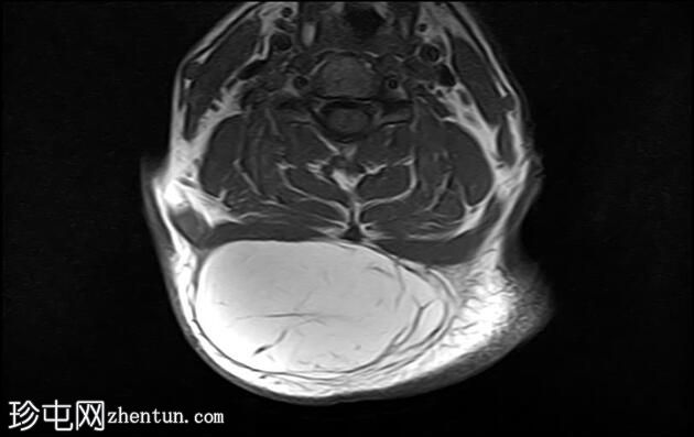 软组织脂肪瘤-颈部