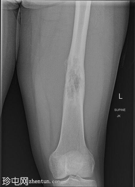 股骨干骨肉瘤
