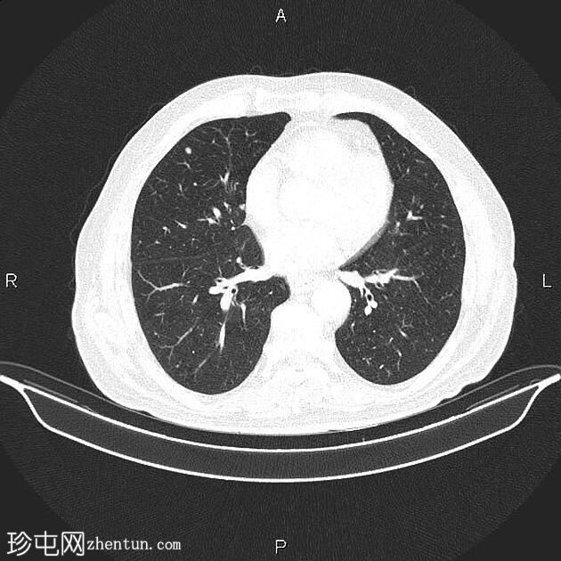 转移性食管胃癌