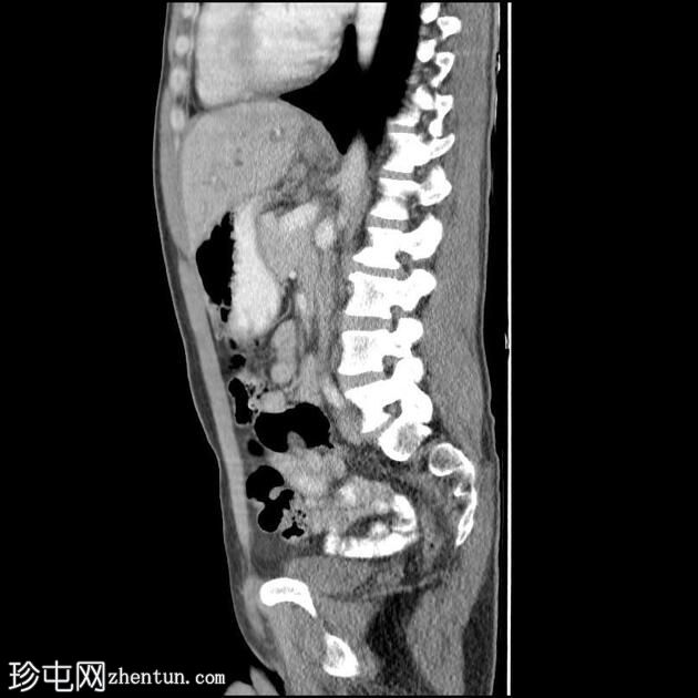 胆总管囊肿