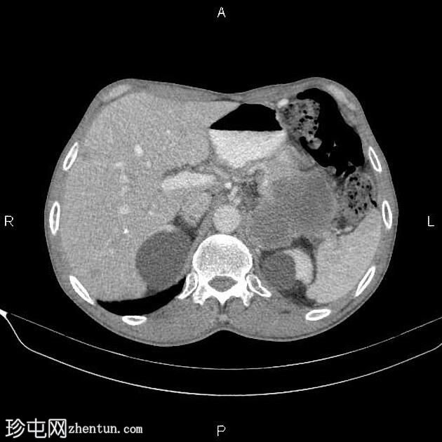 转移性胰腺导管腺癌