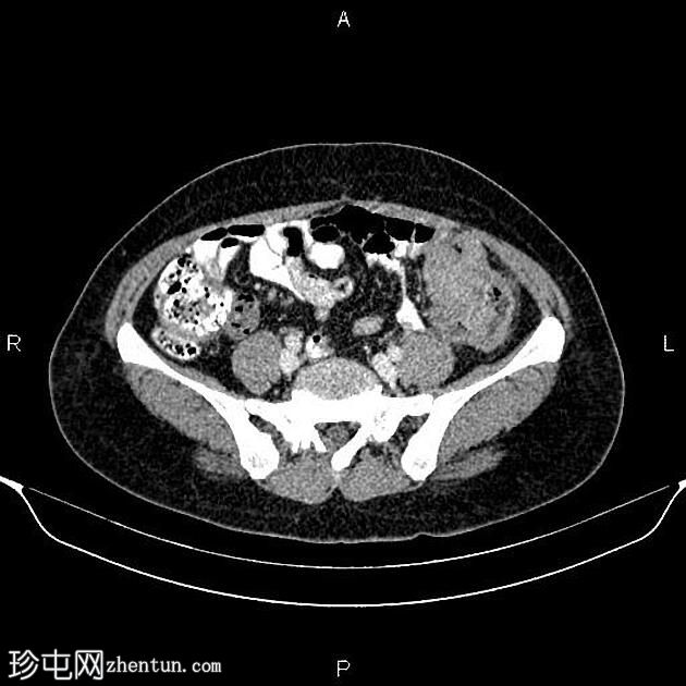 转移性乙状结肠腺癌