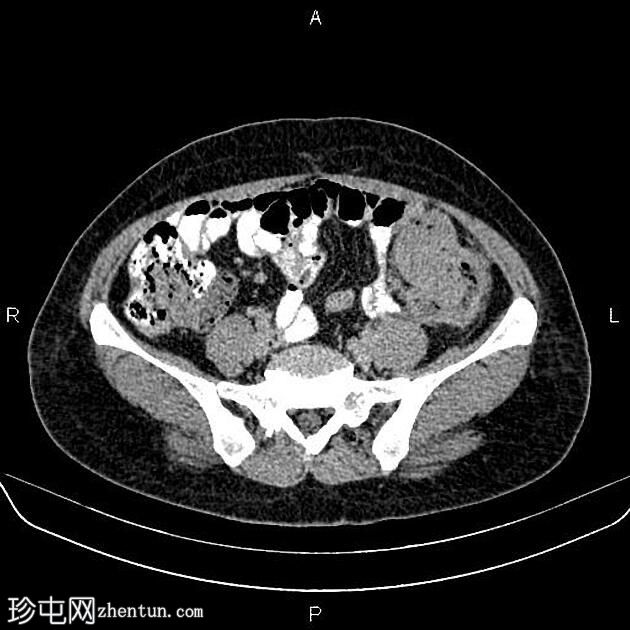 转移性乙状结肠腺癌