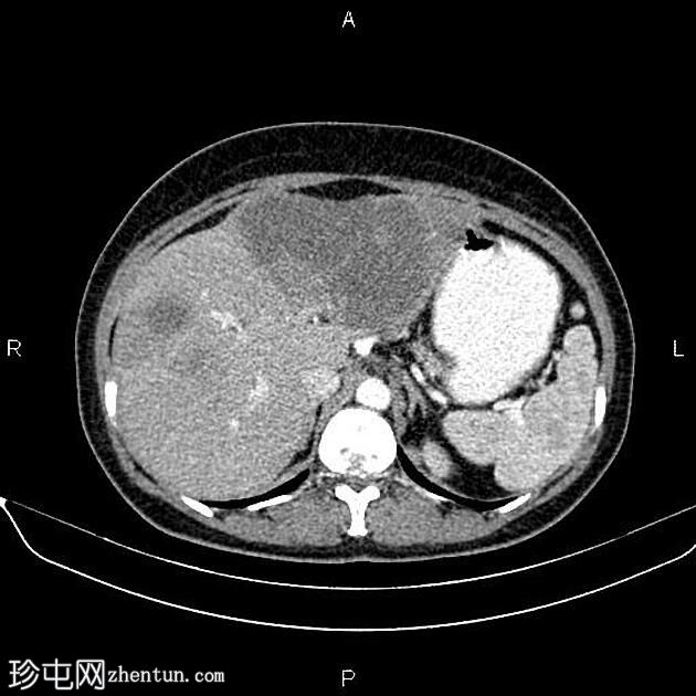 转移性乙状结肠腺癌