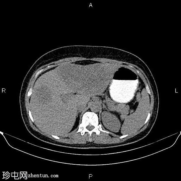 转移性乙状结肠腺癌