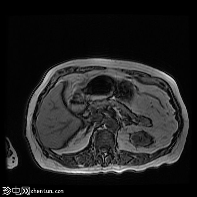 小肠梗阻和胆总管结石