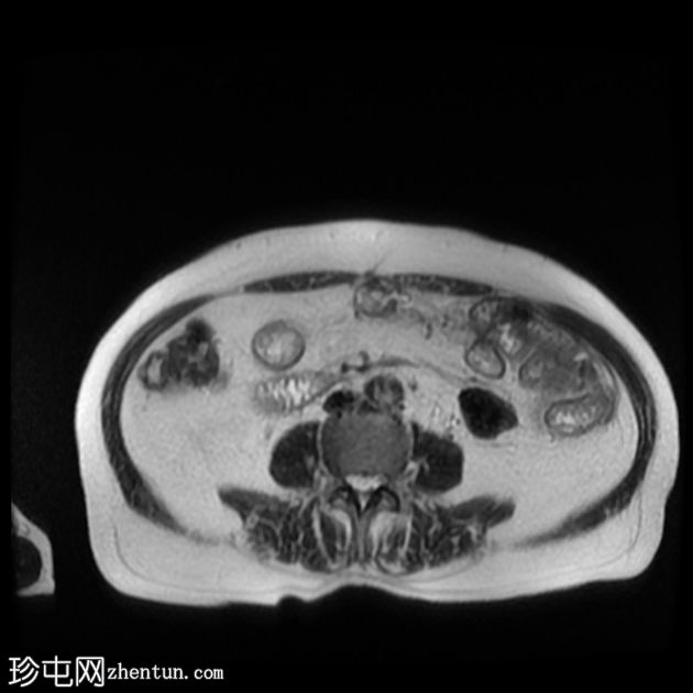 小肠梗阻和胆总管结石