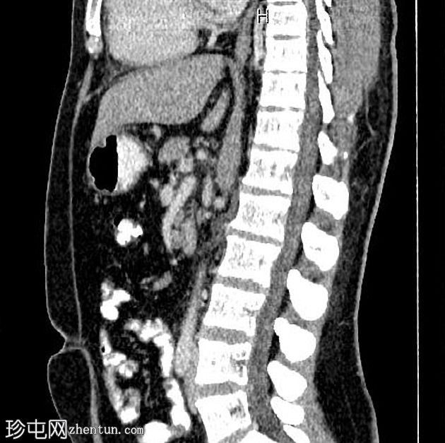 门静脉血栓形成