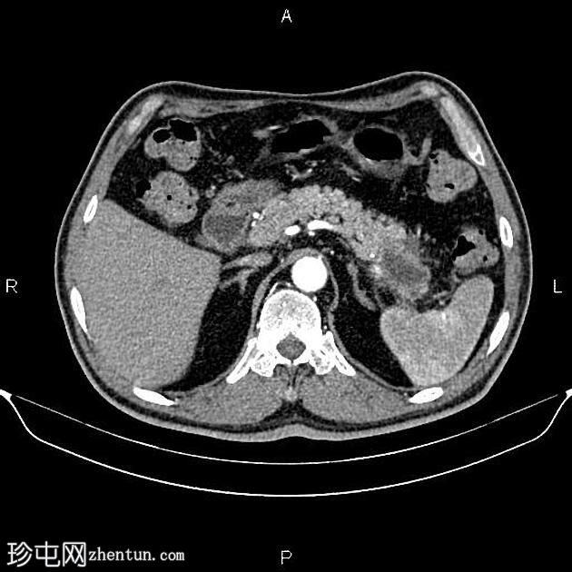 转移性胰腺粘液癌