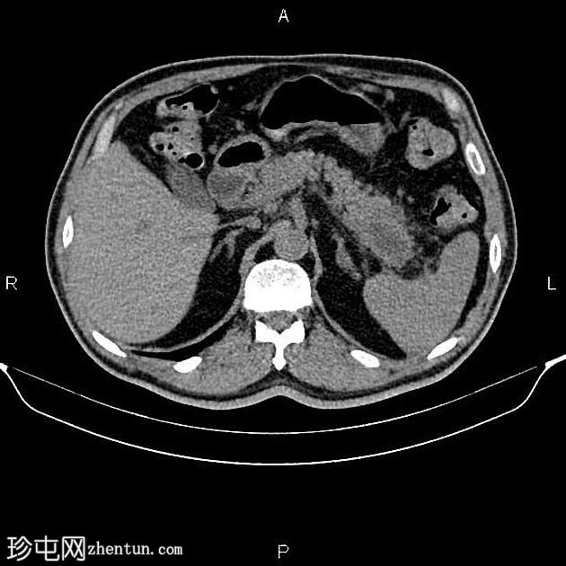 转移性胰腺粘液癌