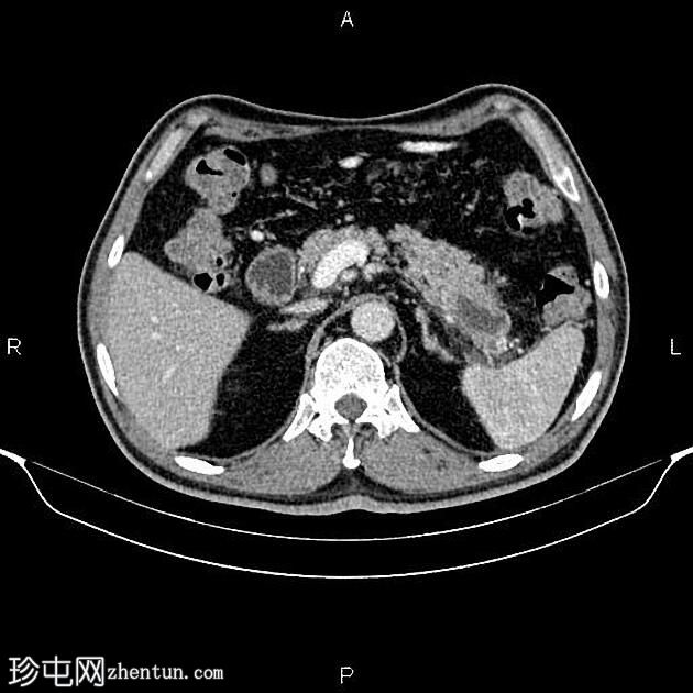 转移性胰腺粘液癌