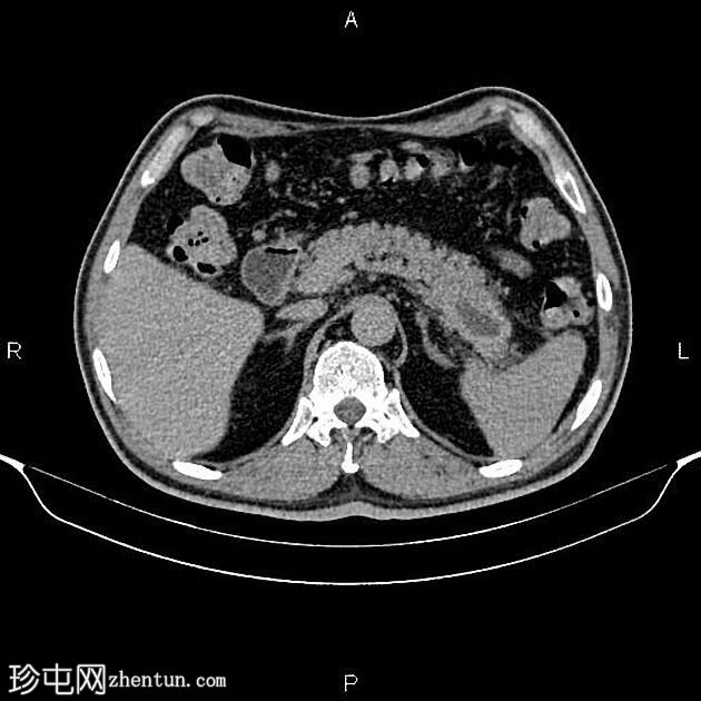 转移性胰腺粘液癌