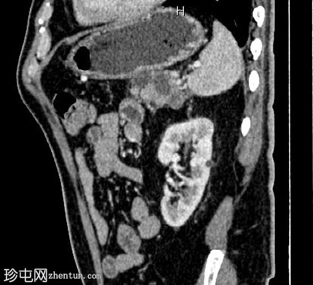 转移性胰腺粘液癌