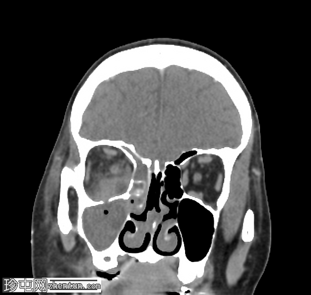 眼眶脓肿伴有真菌性鼻窦炎