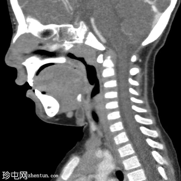 甲状舌管囊肿