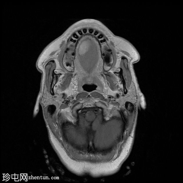 肌内血管瘤（舌）