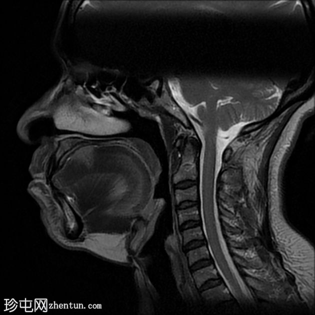 肌内血管瘤（舌）