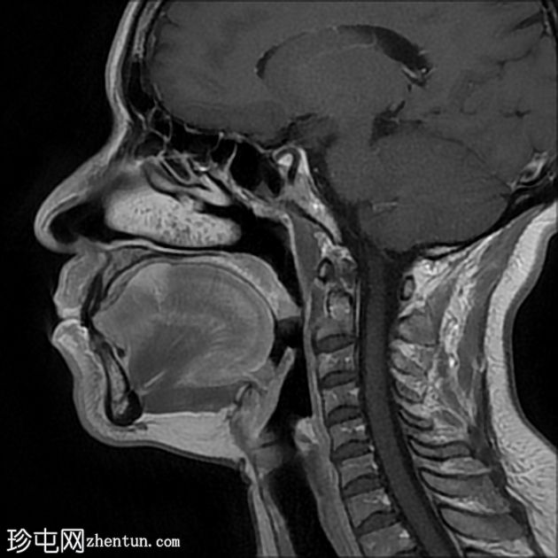 肌内血管瘤（舌）