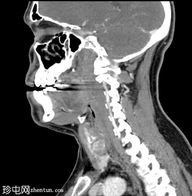 颈长肌钙化性肌腱炎