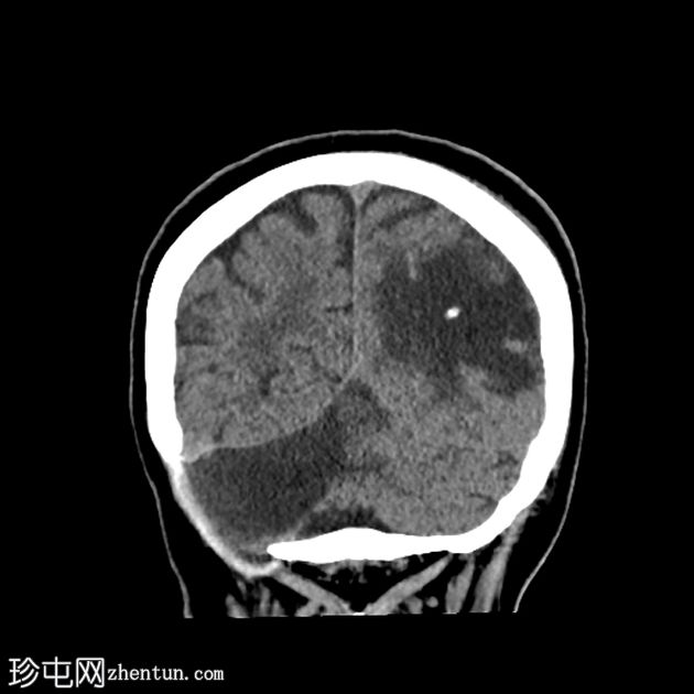 导管周围实质内囊肿