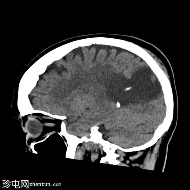 导管周围实质内囊肿