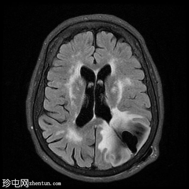 导管周围实质内囊肿